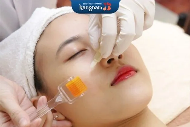 Lăn kim trị sẹo