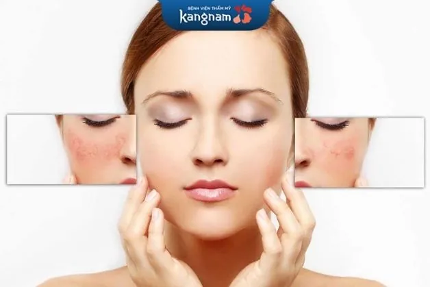Trị sẹo collagen khá hiệu quả