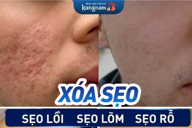 Xóa sẹo hiệu quả tại Kangnam