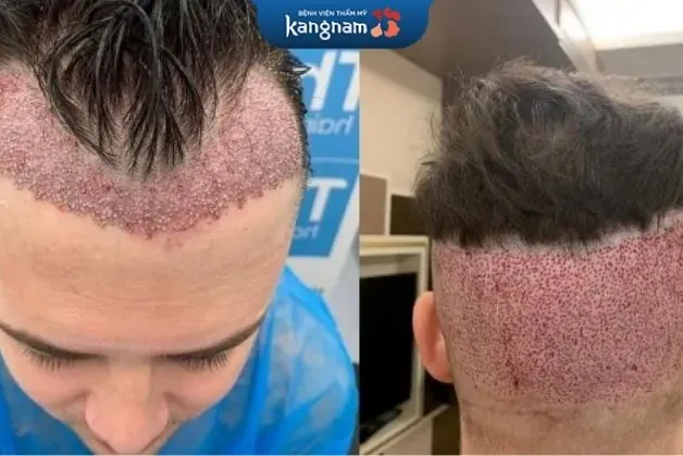 Sau khi cấy tóc khoảng 2 tháng tóc sẽ bắt đầu mọc lại