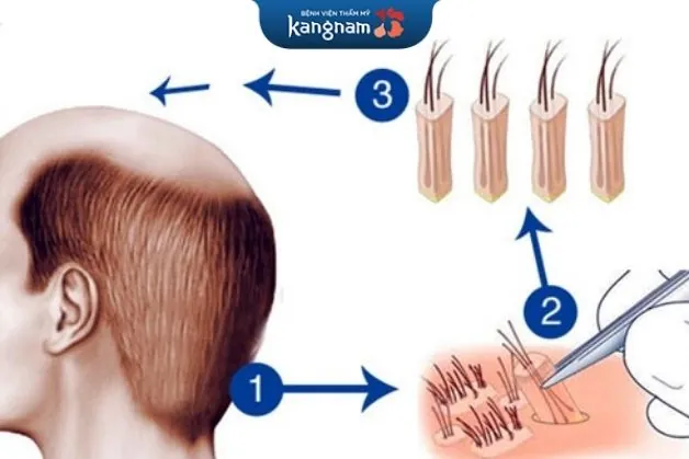 Công nghệ là yếu tố chính quyết định phần lớn đến hiệu quả sau khi cấy tóc