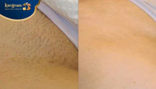 Không bị lộ lông khi mặc bikini sau triệt lông