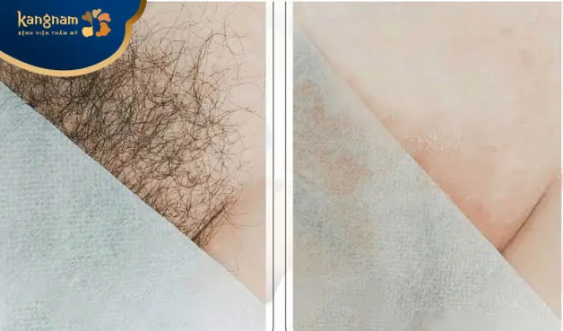 Bạn Trịnh Linh hài lòng sau triệt lông bikini