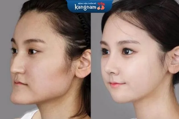 Phẫu thuật chỉnh xương hàm lệch