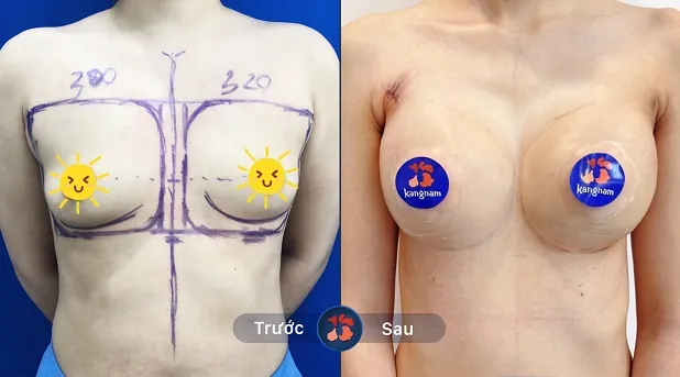 Khách hàng sau khi nâng ngực 6D