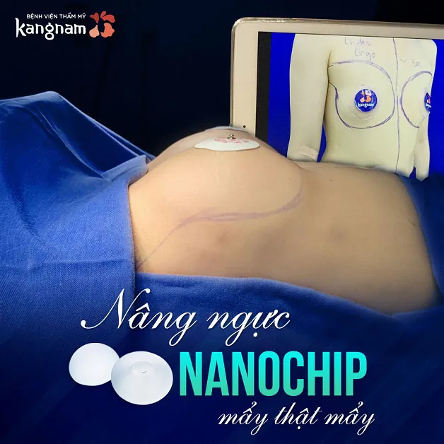 Nano chip là vật liệu nâng ngực dạng gel, sử dụng gel cao cấp