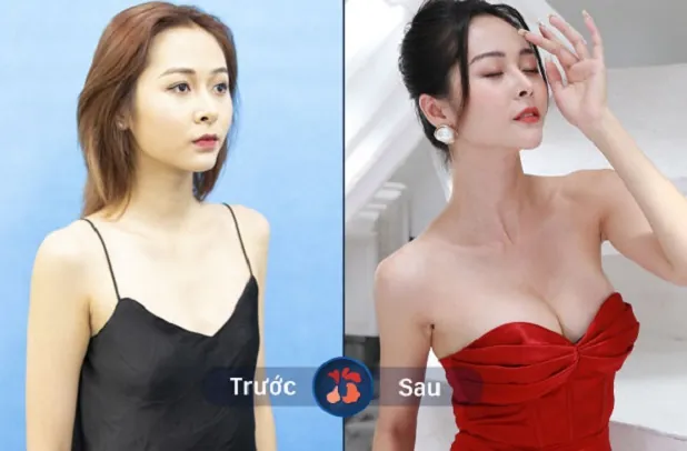 Nâng ngực công nghệ mới cho vòng 1 đầy đặn tự nhiên