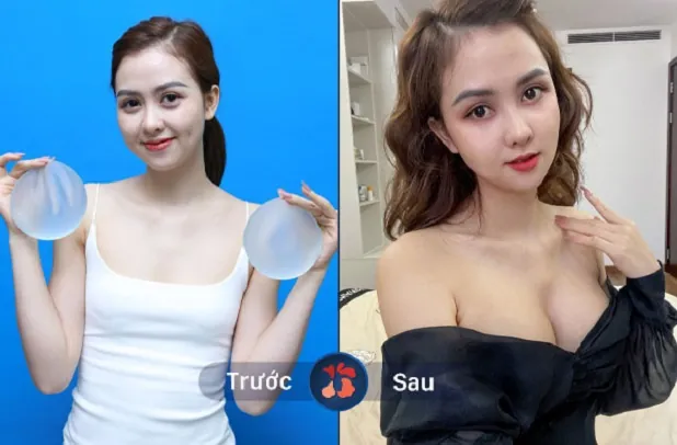 Vòng 1 săn chắc với túi độn cao cấp, không lo tình trạng co thắt bao xơ