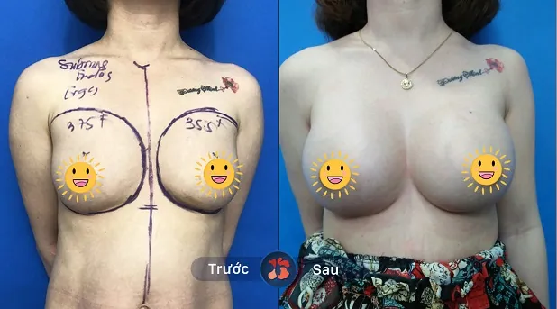 Kết quả nâng ngực căng tròn ấn tượng