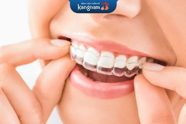 Quá trình niềng răng đơn giản và không cần quá nhiều thời gian chuẩn bị