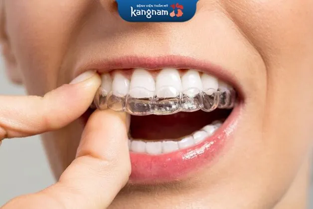 Niềng răng tháo lắp vẫn đem lại hiệu quả đối với người trưởng thành