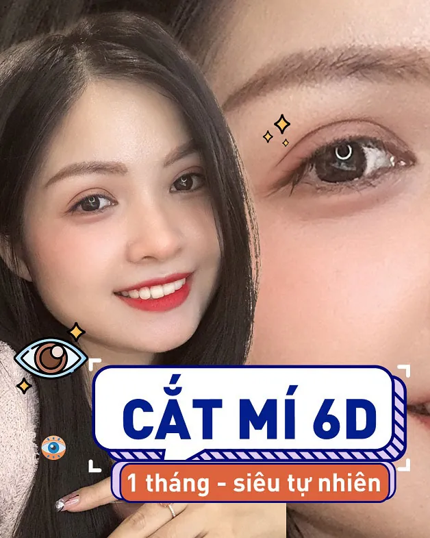 Khách hàng sau khi cắt mí 6D 1 tháng siêu tự nhiên