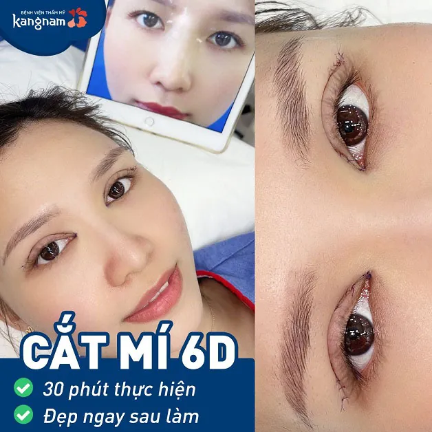 Cắt mí 6D đẹp 30 phút thực hiện, đẹp ngay sau làm