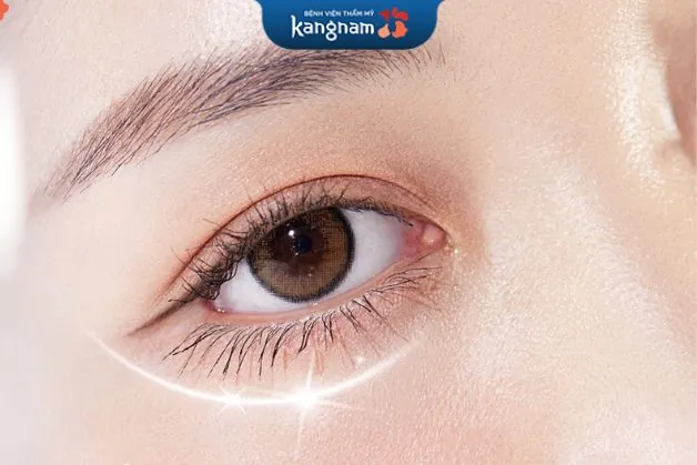 Cắt mí Plasma Plus là gì?