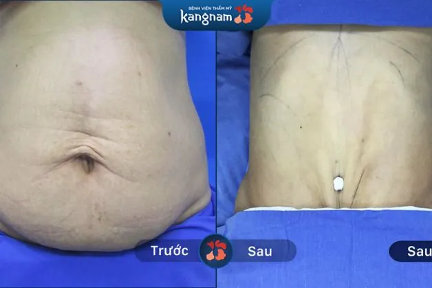 Mỡ bụng lâu năm được loại bỏ tối đa