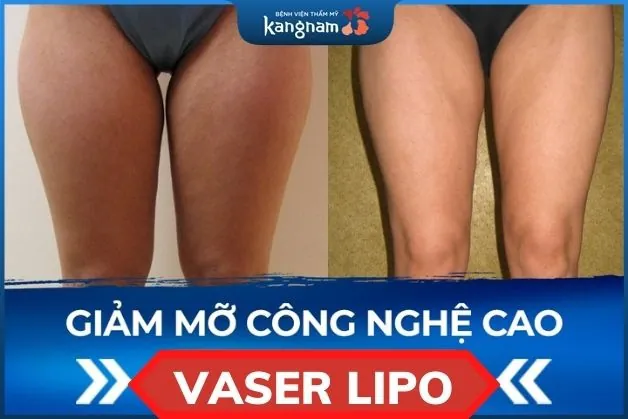 Hút mỡ tại đùi bằng công nghệ Vaser Lipo