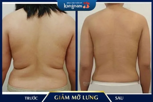 Công nghệ hút mỡ lưng Vaser Lipo