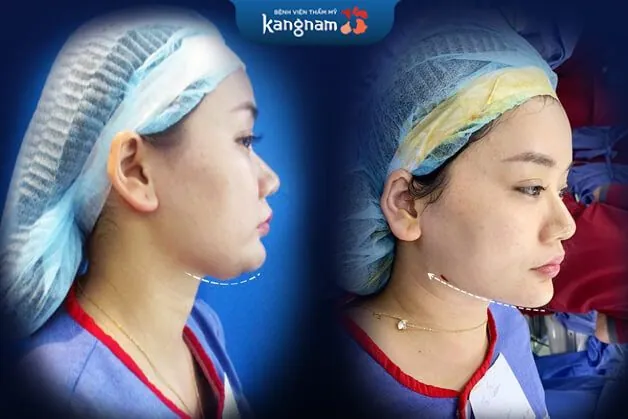 Mỡ cằm được giải quyết triệt để