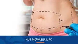 Hút mỡ Vaser Lipo