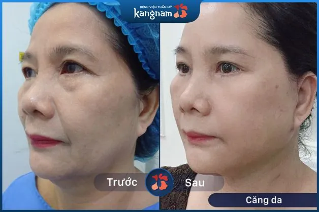 Cải thiện tối đa tình trạng lão hóa da, nếp nhăn và vết chân chim