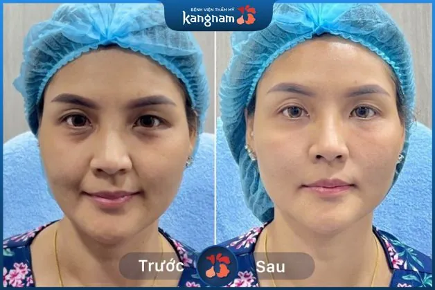 Căng da không can thiệp phẫu thuật, an toàn và hiệu quả cao