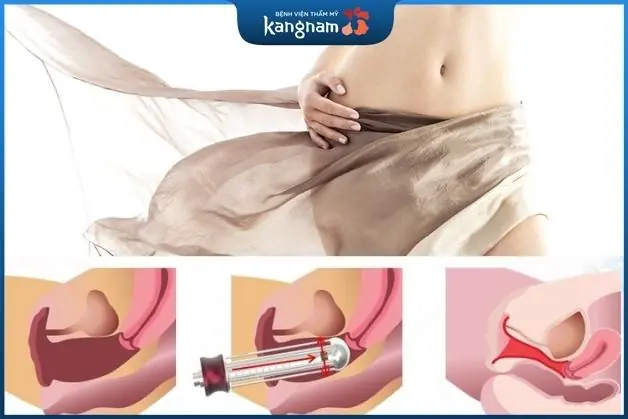 Cơ chế tác động của tia laser với thành âm đạo