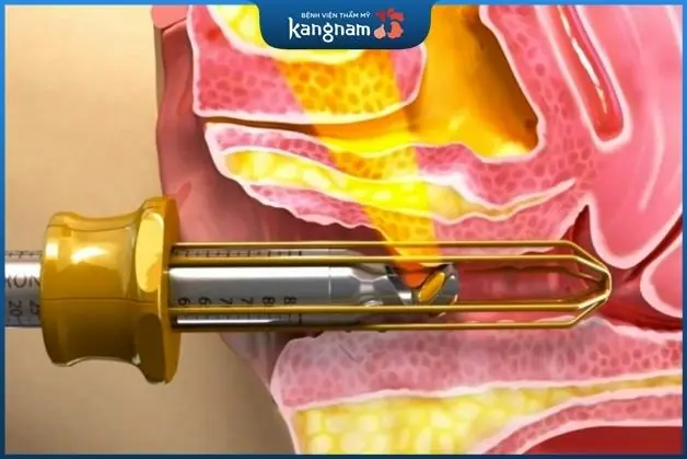 Liệu pháp laser làm đẹp vùng kín được nhiều chị em tin dùng