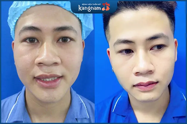 Khách hàng nam sau khi tạo hình môi tim sở hữu vẻ ngoài điển trai