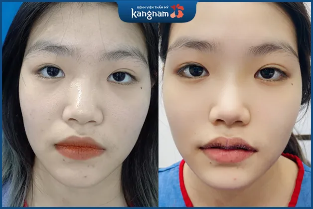 Khách hàng hồi phục nhanh sau tạo hình môi tim 6D