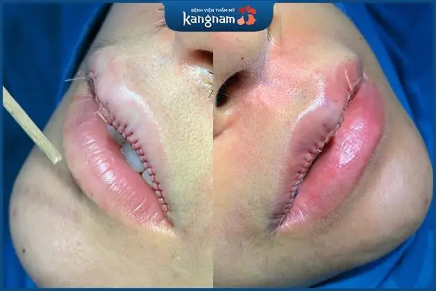 Môi thu mỏng môi 6D ngay sau khi được khâu đóng bằng chỉ Nano