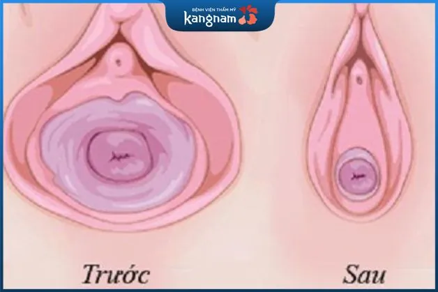 Thu nhỏ vùng kín có nguy hiểm không?
