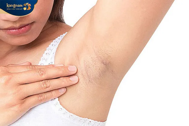 Những ai cần thực hiện căng da vùng nách?