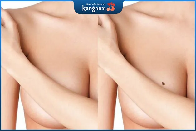 Chỉ trong vòng hơn 1 năm mà kích thước nốt ruồi to lên nhanh chóng