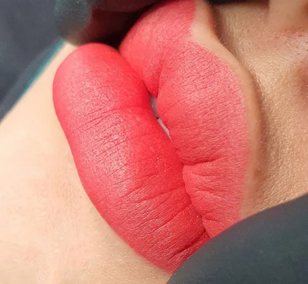 Trong 1 -2 tuần đầu môi vẫn còn sưng