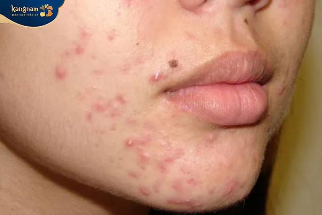 Nhiều trường hợp bị viêm da sau khi triệt râu giá rẻ tại các cơ sở hoạt động chui