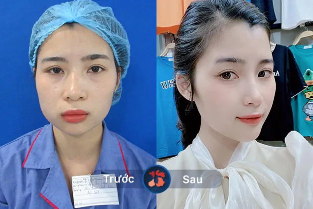 Khắc phục dáng cằm vuông, lệch, giúp gương mặt trở nên thon gọn