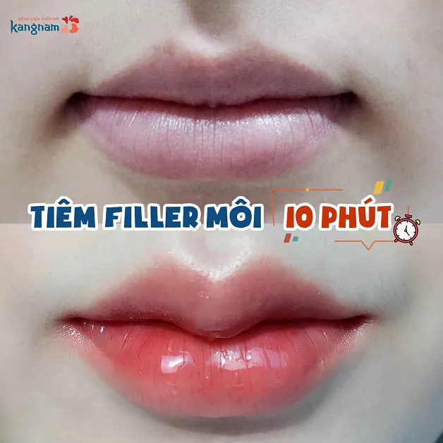 Quá trình thực hiện nhanh chóng, thấy rõ kết quả môi trái tim sau khi tiêmQuá trình thực hiện nhanh chóng, thấy rõ kết quả môi trái tim sau khi tiêm