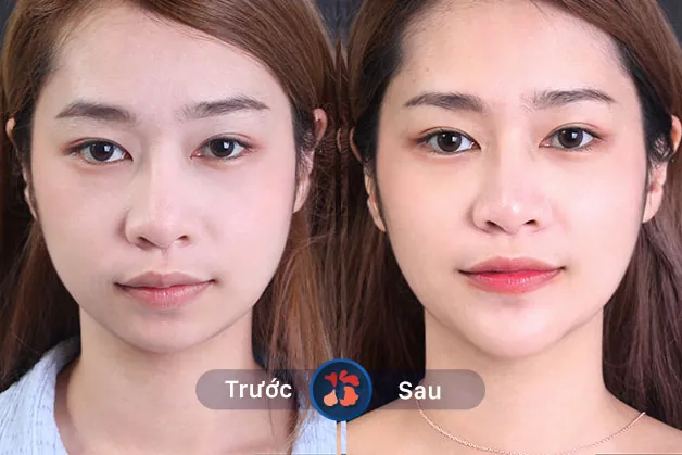 Gương mặt chị khách trở nên sắc sảo hơn sau khi độn cằm