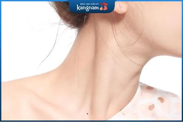 bạn vẫn có thể xóa nốt ruồi mọc tại hõm cổ nếu chúng ảnh hưởng đến tính thẩm mỹ