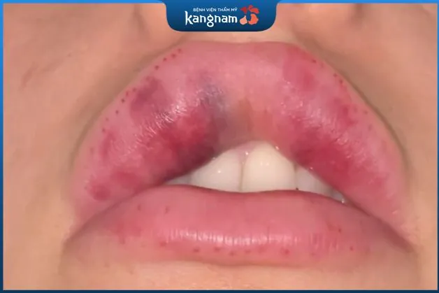 Dấu hiệu tiêm filler môi bị hoại tử