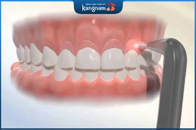 Cắt nướu chữa cười hở lợi là phương pháp làm đẹp đơn giản