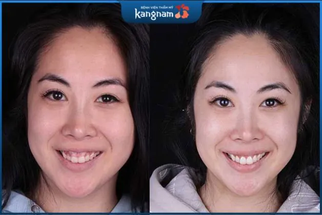 Thành quả khách hàng cắt nướu tại Kangnam