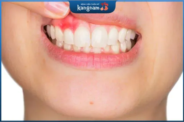 Sưng tấy vùng miệng ảnh hưởng trực tiếp đến việc ăn uống