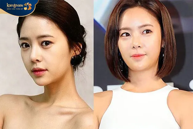 Độn trán giúp làm đầy vùng trán lõm, ngắn, trẻ hóa da toàn diện