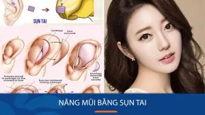 Nâng mũi bằng sụn tai