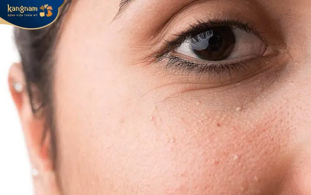 Thay đổi nội tiết tố trong cơ thể có thể gây nên tình trạng mụn thịt