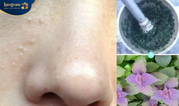 Trị mụn thịt cho bà bầu bằng lá tía tô