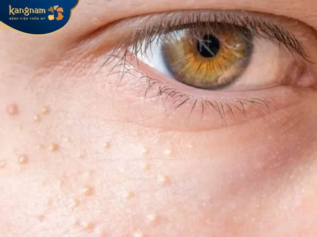 Mụn thịt khi mang thai do tác động bên ngoài