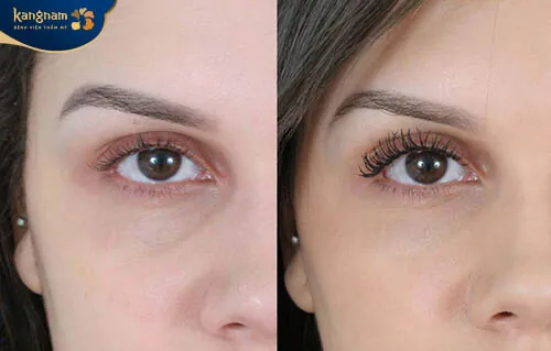 Những người vùng mắt bị thâm sạm, nhăn nheo