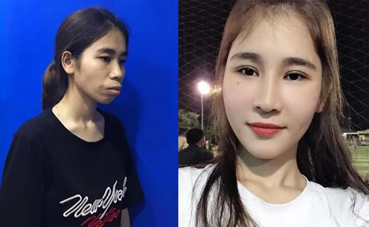 Cao Lan “lột xác" sau khi phẫu thuật thẩm mỹ